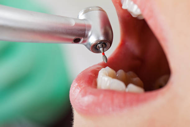 Best Emergency Wisdom Tooth Extraction in Barnsdall, OK